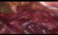 Laparoscopic treatment of inguinal and femoral hernias