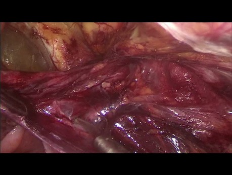 Laparoscopic treatment of inguinal and femoral hernias