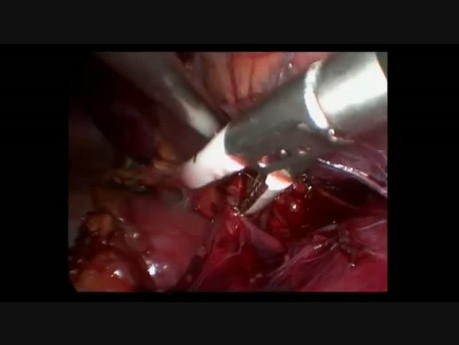 Right Adrenalectomy - Transabdominal Clipless Hibrid Minilaparoscopic Technique