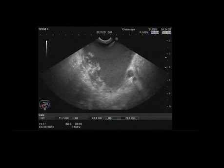 Endoscopic Ultrasound of Pancreatic Walled Off Necrosis  