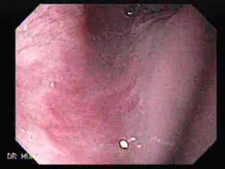 Esophageal Squamous Cell Carcinoma - 60 Year-Old Female
