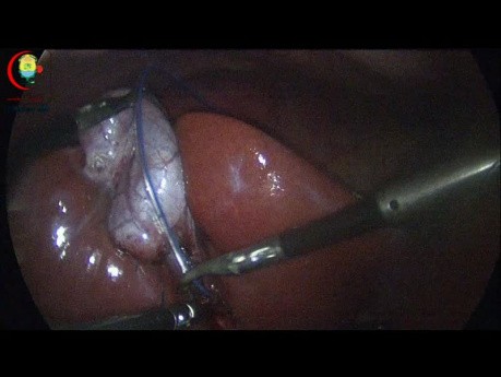 Test for Patency of the Cystic Duct and CBD