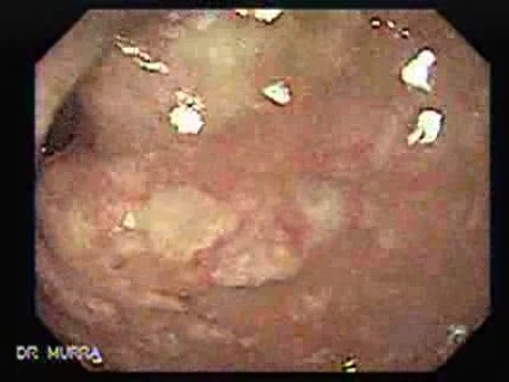 Rectum (12 of 30)