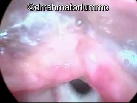 Hoarse Voice caused by Laryngeal Web 