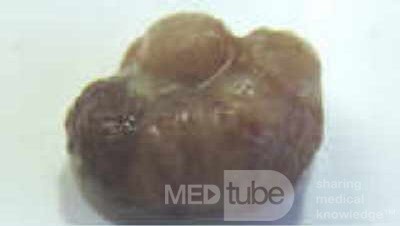 Malign Polyp (3 of 8)