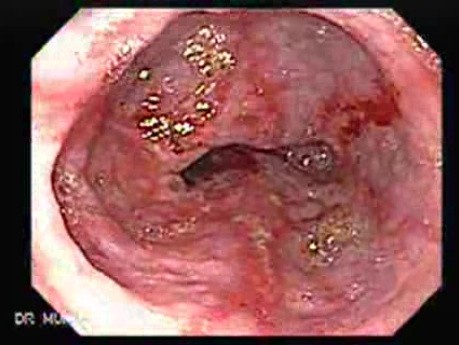 Reflux Esophagitis & Hiatal Hernia