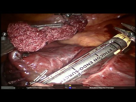 Robotic S3 - Segmetnectomy / Lung Resection