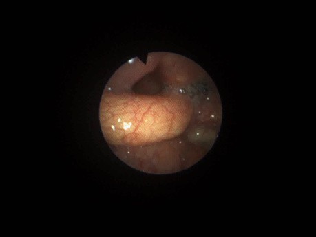 Post-operative Swallowing Video Endoscopy Assessment