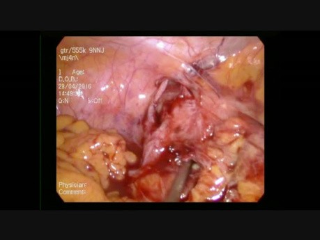 Appendicular Abscess