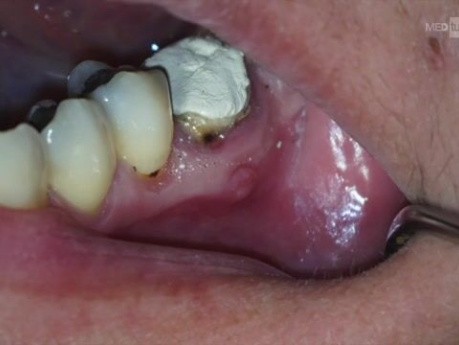 How to Remove Silver Cones