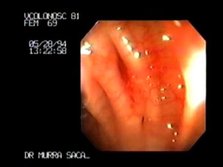 Inverted Diverticulum