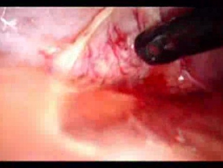 Colonic Perforation With Peritonitis - Laparoscopy (44 of 46)