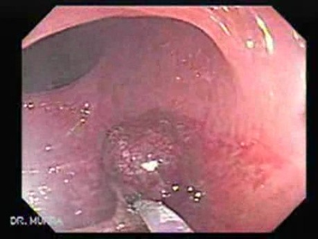 Pedicled Polyp (6 of 7)