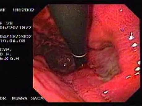 Evolution of a Gastric Carcinoma without a Treatment (5 of 10)