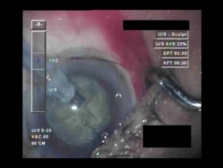 Cataract Surgery - Part 3