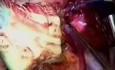 Rapid Sequence Heart and Lung Transplant