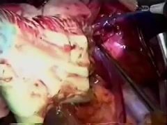 Rapid Sequence Heart and Lung Transplant