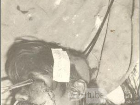 Injury Left Eyeiron Rod Passing From Orbit To Occipet (Gun Shot)