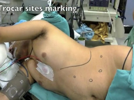 Laparoscopic splenectomy