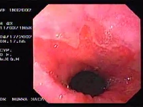 Barrett´s Esophagus (1 of 2)
