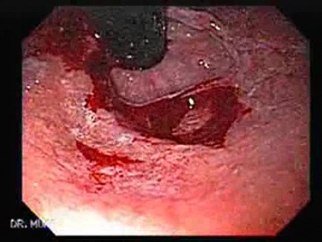 Iatrogenic Mallory-Weiss Tears