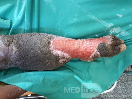 Ulcerating Lymphedema