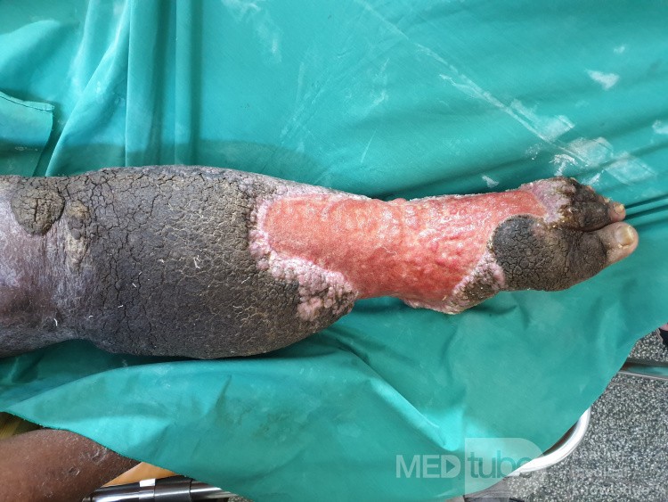 Ulcerating Lymphedema