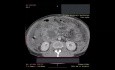 Abdominal Contrast Enhanced Computed Tomography in the Patient with Walled-off Pancreatic Necrosis