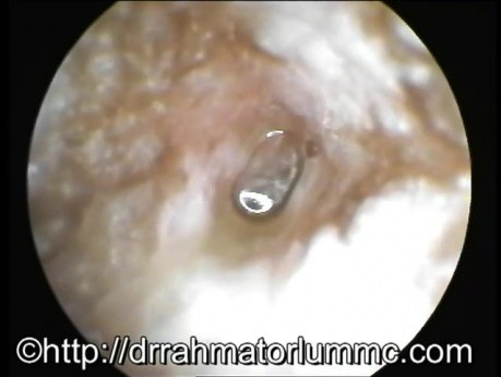 Active Stage of Chronic Suppurative Otitis Media-Pulsating Air Bubble 