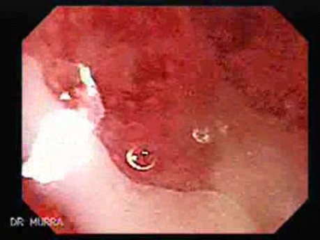 Colitis Ulcerosa - Pancolitis (4 of 7)