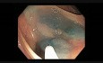 Colonoscopy Channel - Non-lifting Sign Indicated Cancer In Serrated Adenoma