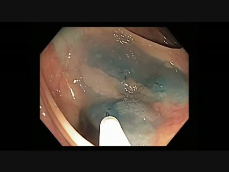 Colonoscopy Channel - Non-lifting Sign Indicated Cancer In Serrated Adenoma