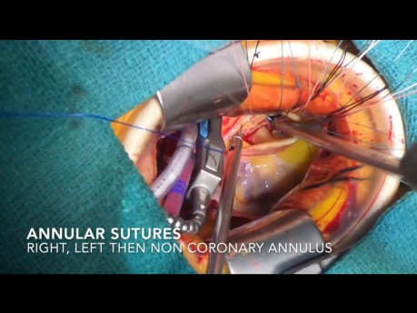 Minimally Invasive Aortic Valve Replacement for Severe Aortic Regurgitation