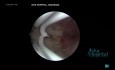 Hysteroscopic Septum Resection Complete Intrauterine Septum up to Internal OS