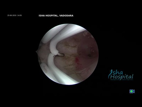 Hysteroscopic Septum Resection Complete Intrauterine Septum up to Internal OS