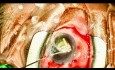 Dislocated IOL Exchange with Yamane Fixation, Part 1