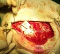 Acute Spontaneous Subdural Hemorrhage in the Subdural Space
