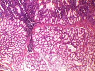 Brunner's Gland Adenoma (3 of 4)