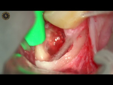 Impacted Wisdom Tooth Extraction Under Microscope
