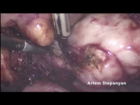 Laparoscopic Myomectomy