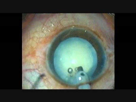Fugo Blade Capsulorhexis