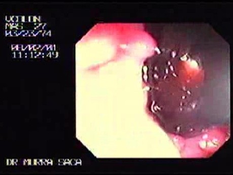 Familial Adenomatous Polyposis of the Colon (15 of 29)