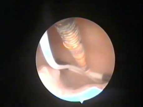 Contraception Complication - Missed Parts of Intrauterine Device Management