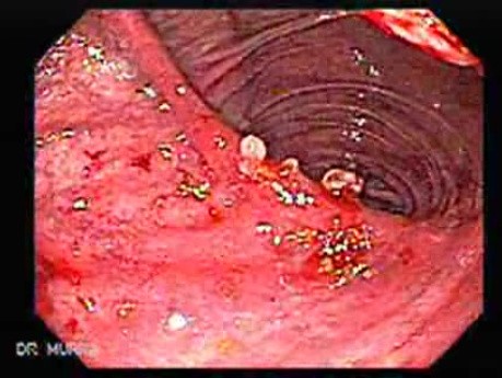 Recurrent Gastric Cancer after Gastrectomy Billroth II (4 of 6)