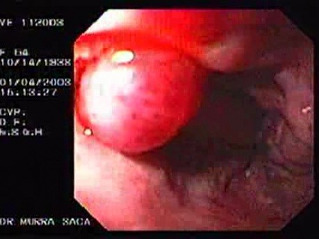 Banding of Esophageal Varices - Closer Look at the Ligated Varix