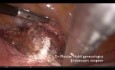 Laparoscopic Cervico-isthmic Cerclage