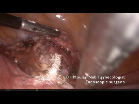 Laparoscopic Cervico-isthmic Cerclage