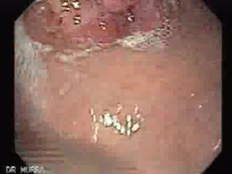 Multilobulated Gastric Polyp (4 of 20)