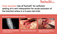 Use of TachoSil® For Sufficient Sealing of a Vein Interposition for Acute Occlusion of the Brachial Artery in a 5-year-old Child