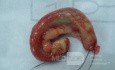 Acute appendicitis with visible lymph node